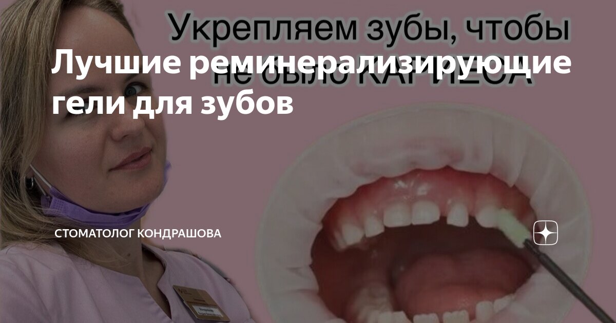 Лучшие реминерализирующие гели для зубов | Стоматолог Кондрашова | Дзен