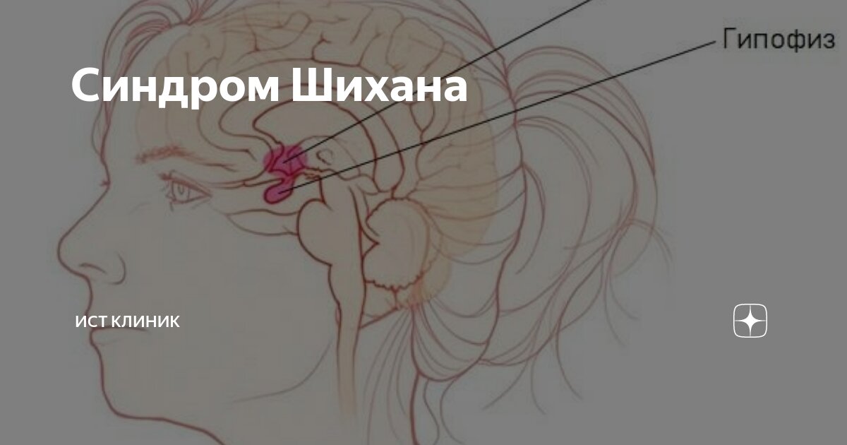 Синдром Шихана | Ист Клиника - неврология, ортопедия, остеопатия. | Дзен