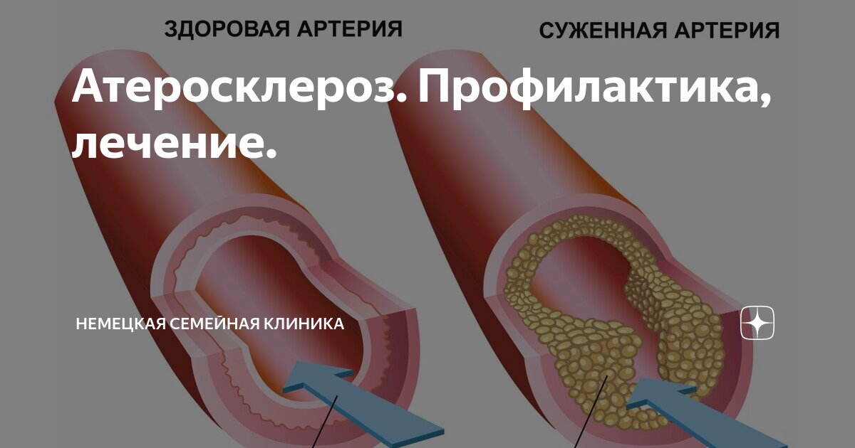 продукты не рекомендуемые при атеросклерозе