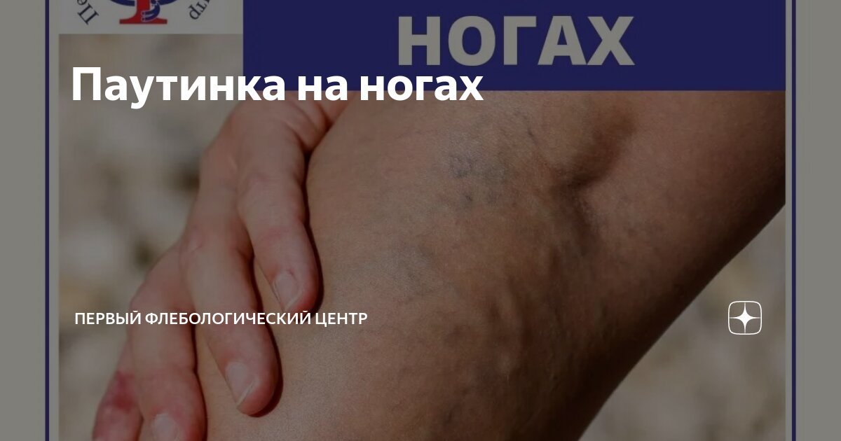 Звездочки на ногах: причины появления, профилактика, лечение