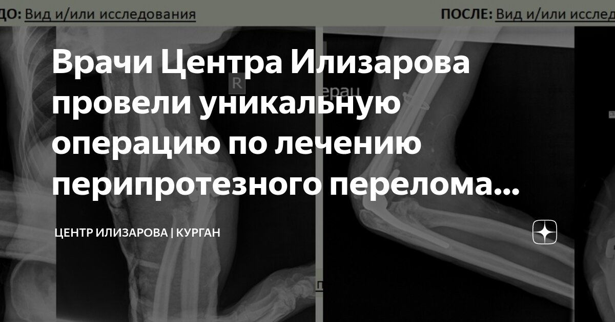 Врачи Центра Илизарова провели уникальную операцию по лечению ...