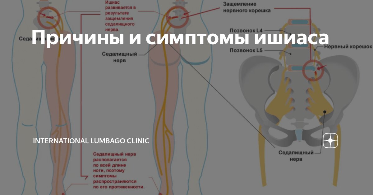Люмбаго с ишиасом что за диагноз Люмбаго с ишиасом что за диагноз