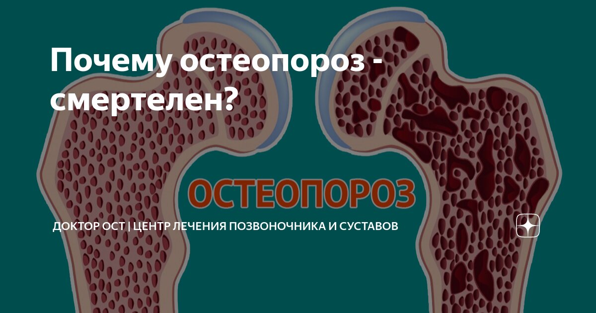 Остеопороз тазобедренного сустава. Низкая плотность костной ткани. Остеопороз позвоночника. Возрастные изменения позвоночника. Остеопения.
