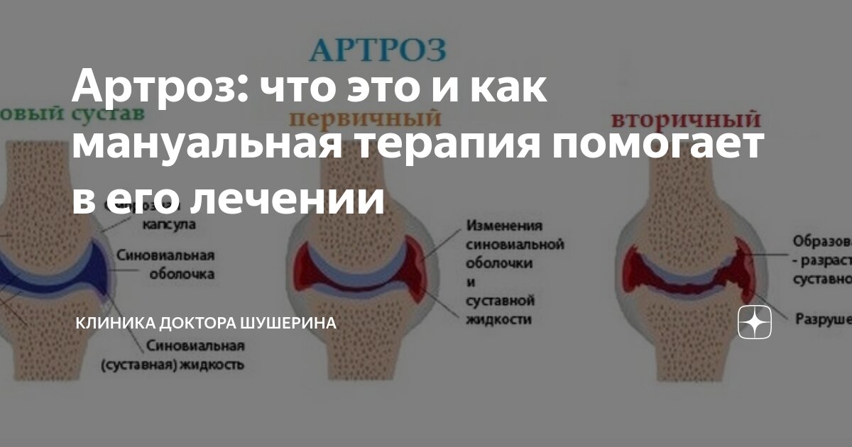 Артроз суставов и как его лечить. Артроз суставов и как его лечить