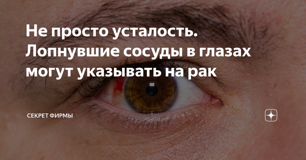 В глазах лопаются сосуды: есть ли причины для паники? - kctg