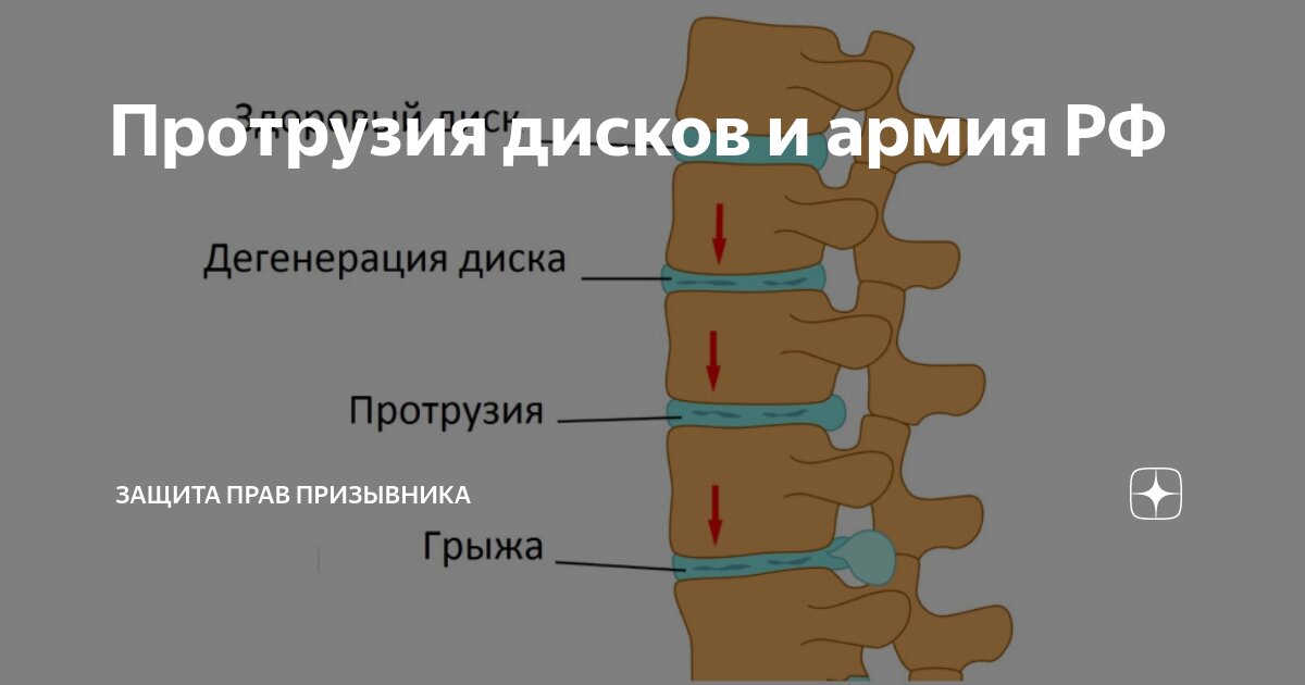 Протрузия дисков и армия РФ | Защита Прав Призывника | Дзен