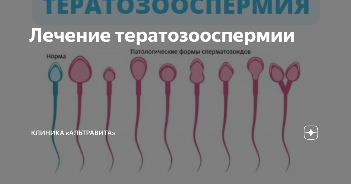 Спермограмма с морфологией по крюгеру. Тератозооспермия спермограмма. Спермограмма нормозооспермия. Тератозооспермия вискозипатия что это. Лечение тератозооспермии у мужчин.