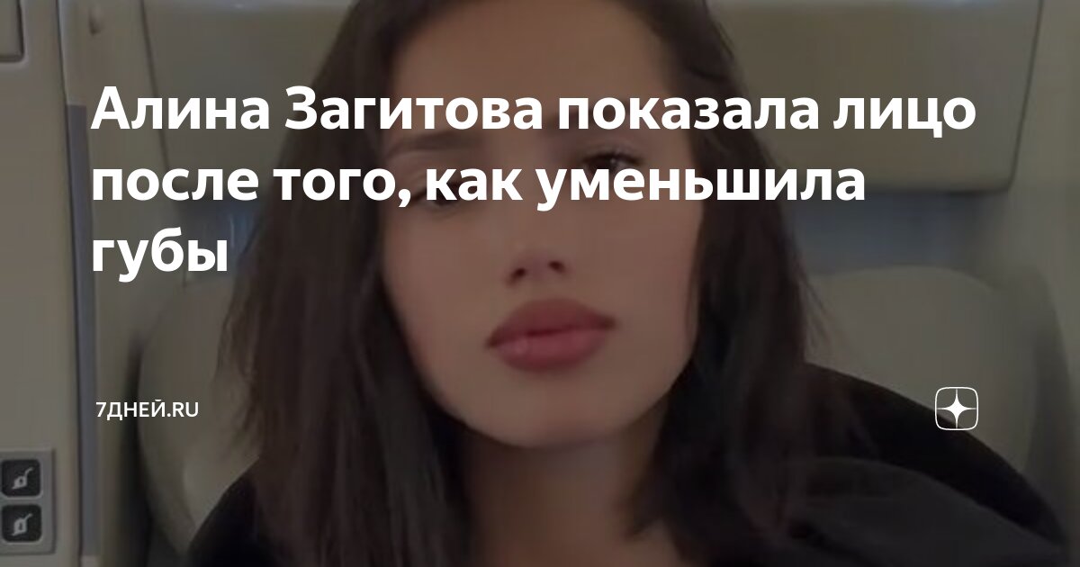 Алина загитова до и после пластики фото