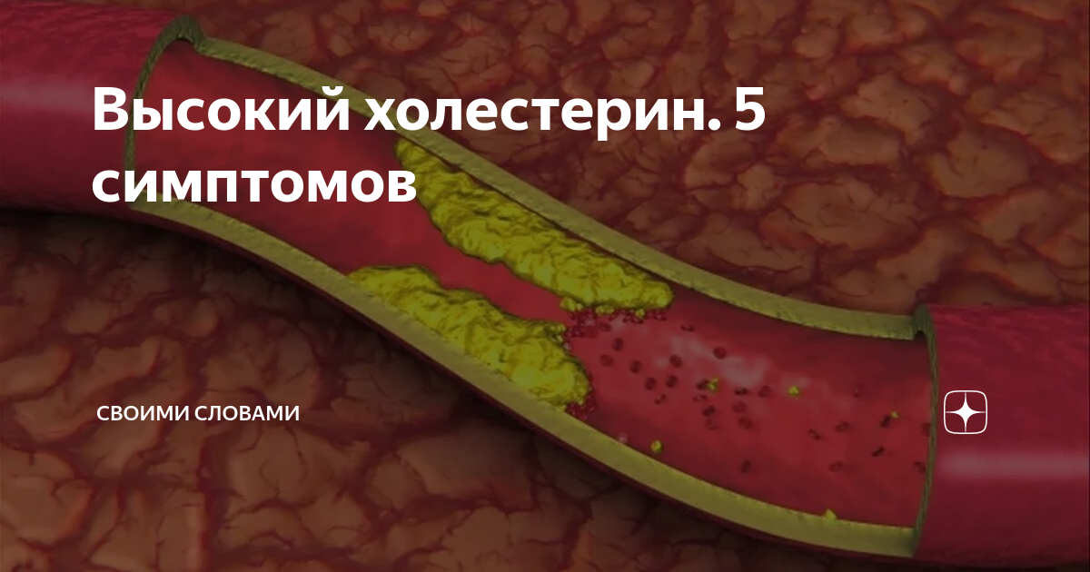 Холестерин на коже как выглядит Гиперхолестеринемия: причины, симптомы и лечение в статье кардиолога Зафираки В.