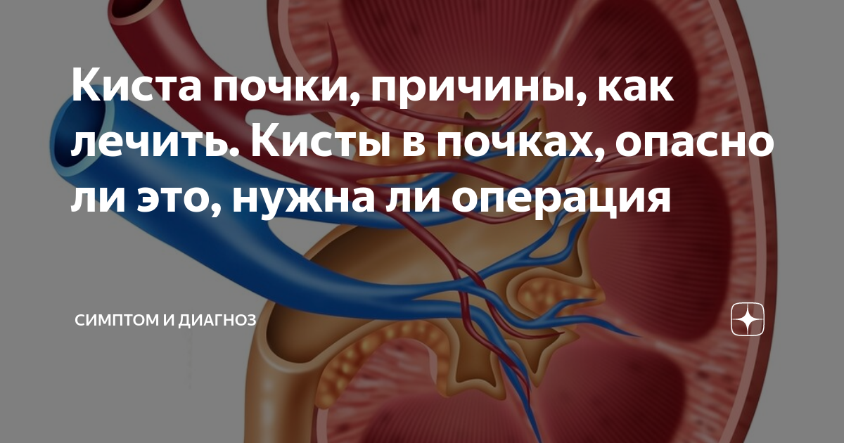 Кисты почки нужна ли операция