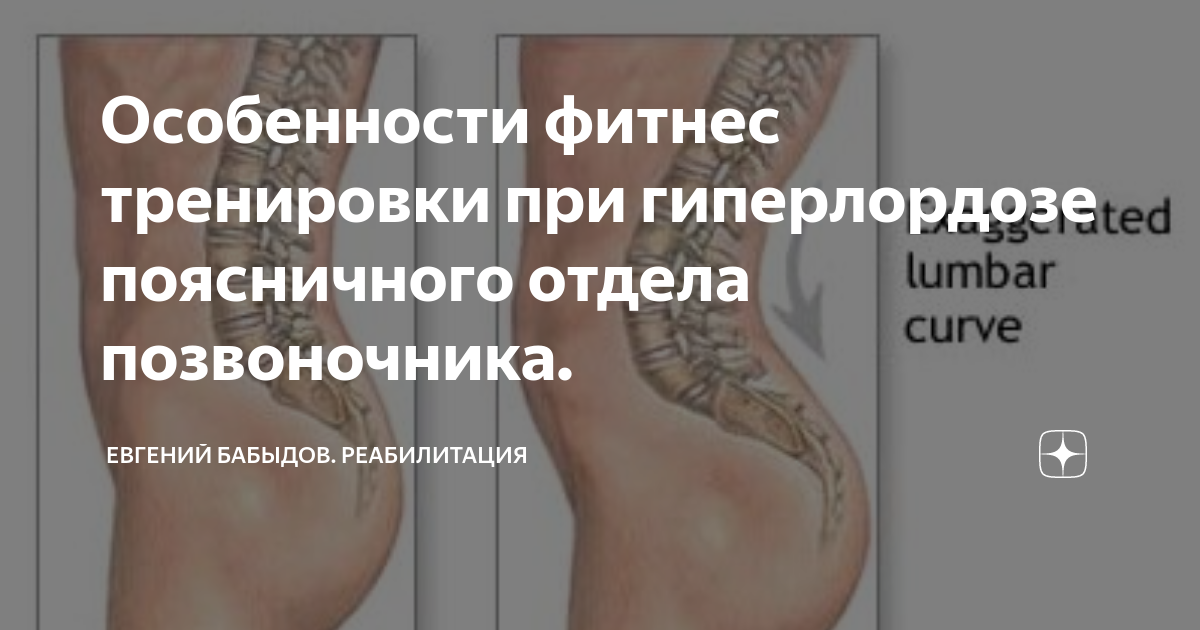 Упражнения от гиперлордоза у женщин