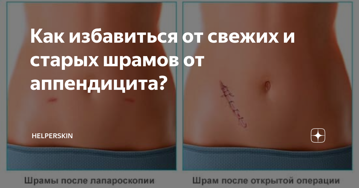 Истории одного хирурга: Снова об аппендиците