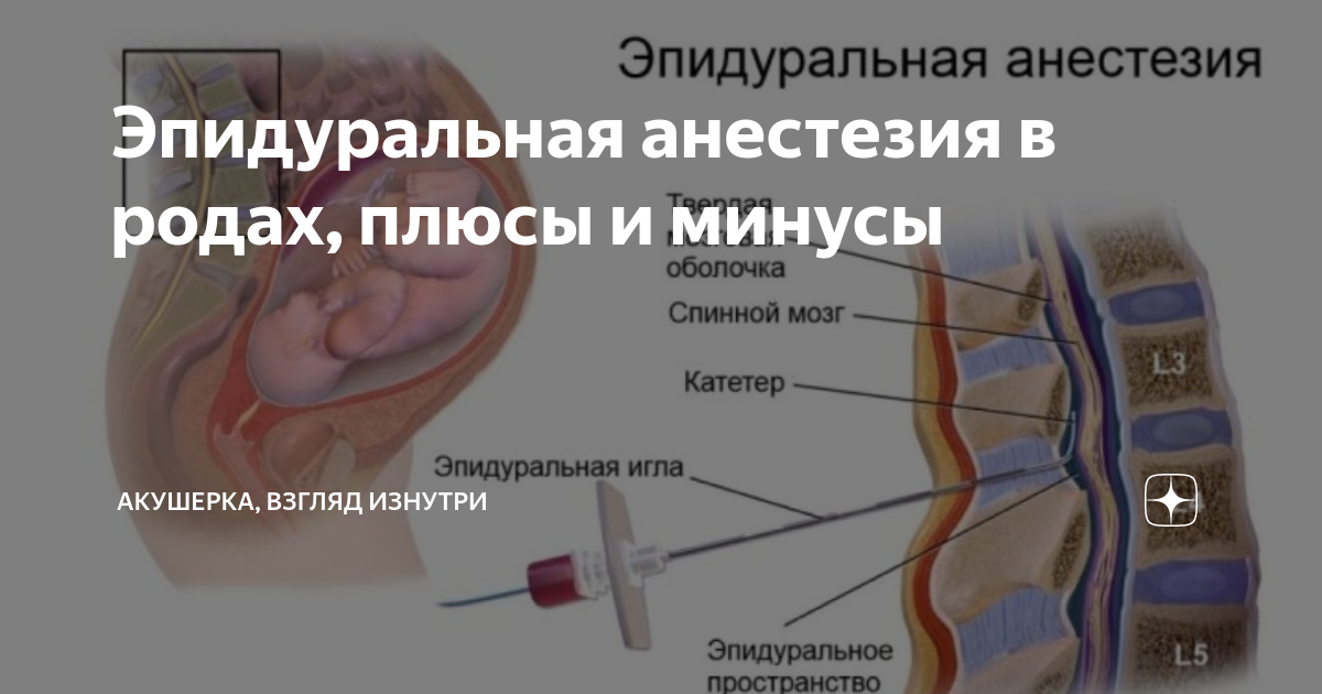 Высокая эпидуральная анестезия. Эпидуральная анестезия картинки. Эпидуральная анестезия при родах.