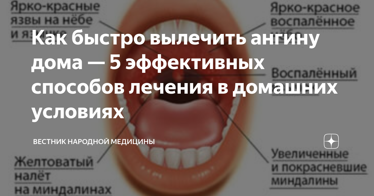 Лечение ангины в домашних условиях: как быстрее выздороветь?