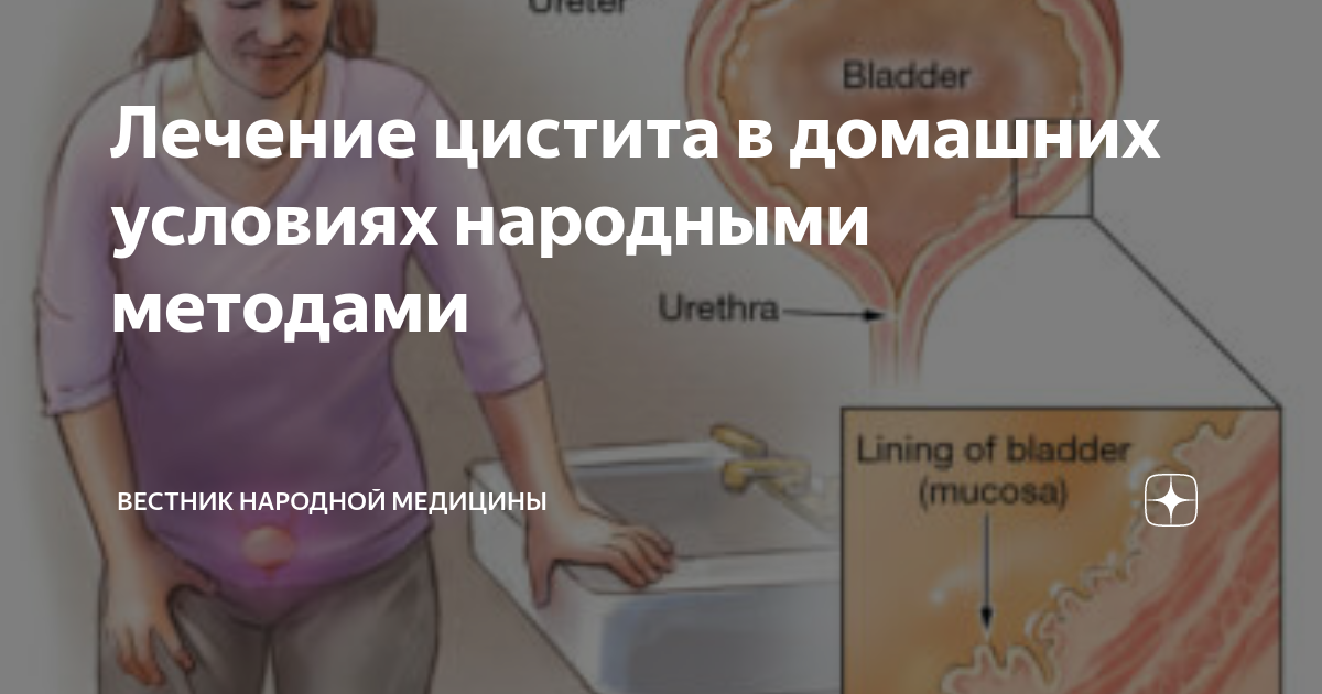 Лечение цистита в домашних условиях народными средствами