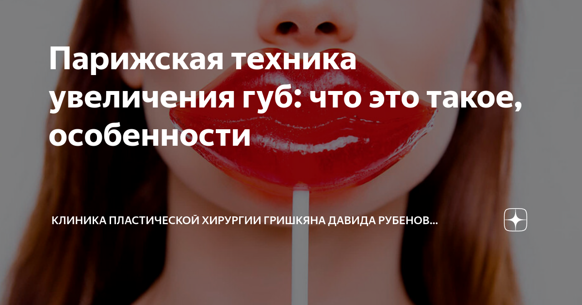 Парижская техника увеличения губ до и после Парижская техника увеличения губ 79 фото