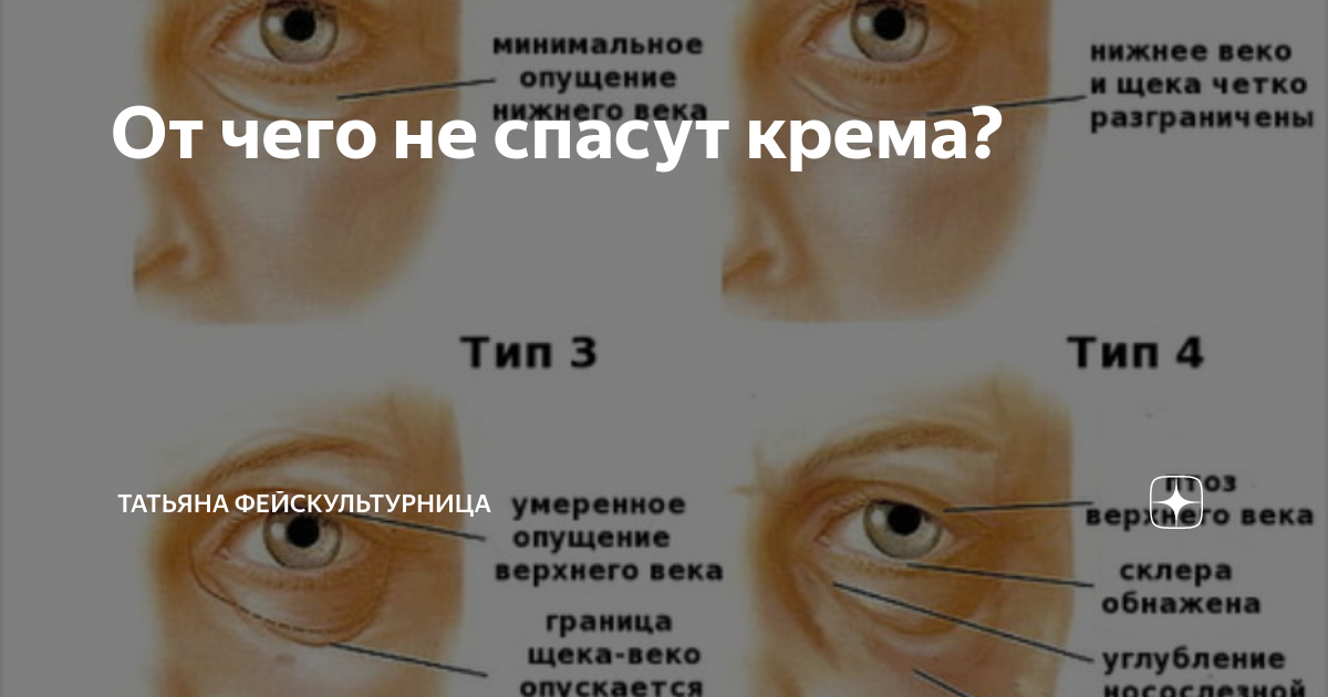 Птоз века мкб 10. Птоз верхнего века причины возникновения у взрослых. Гравитационный птоз щек. Гравитационный птоз тканей. Птоз верхнего века классификация.