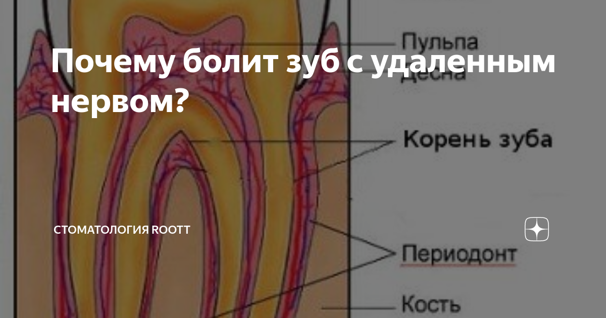 Зуб реагирует на горячее после удаления нерва. Запломбированный зуб реагирует на горячее. Зуб реагирует на горячее после удаления нерва. Зуб реагирует на горячее после удаления нерва. Штифт зубной в канал зуба.