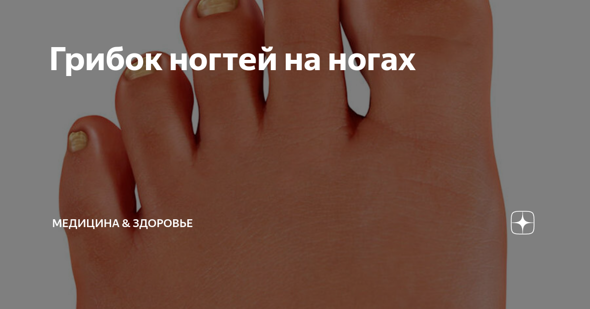 Настойка прополиса от грибка ногтей - схема | Propolis, Birkenstock gizeh, Birkenstock