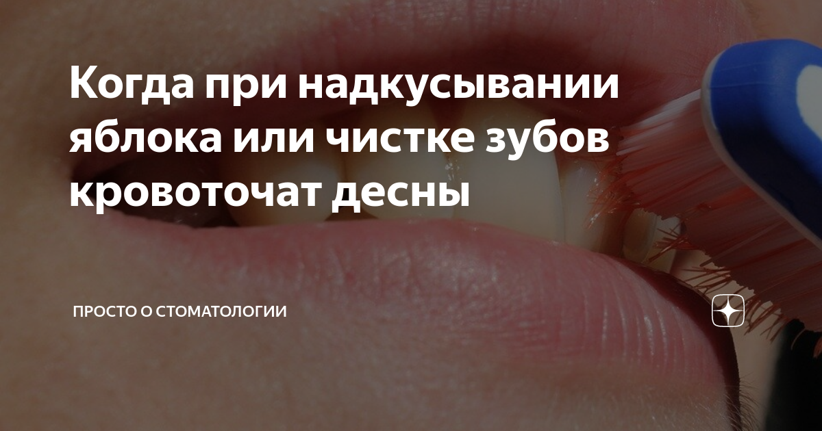 Когда при надкусывании яблока или чистке зубов кровоточат десны ...