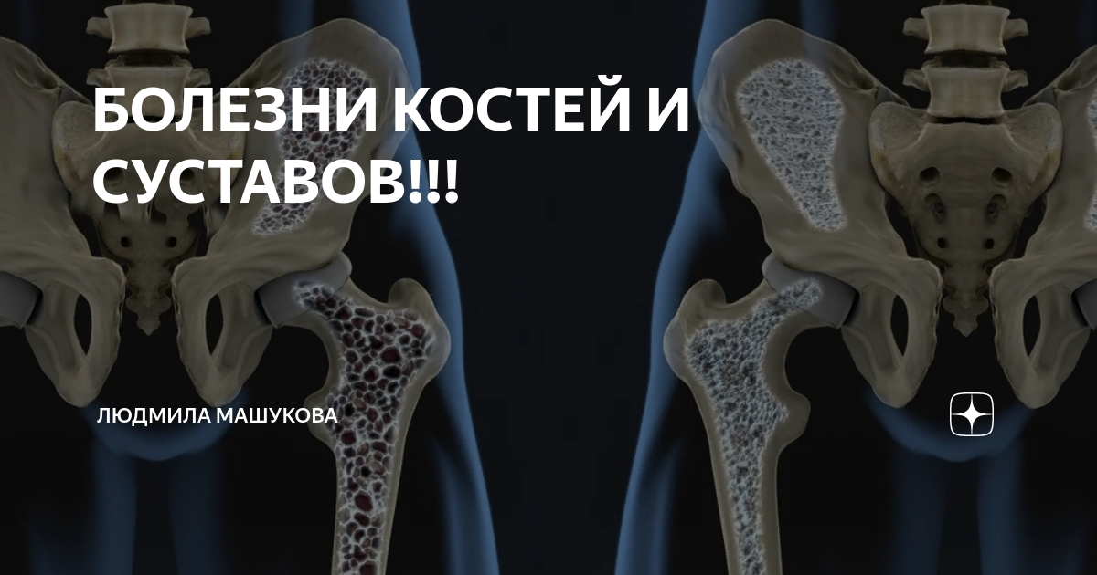 Заболевание костей Заболевание костей