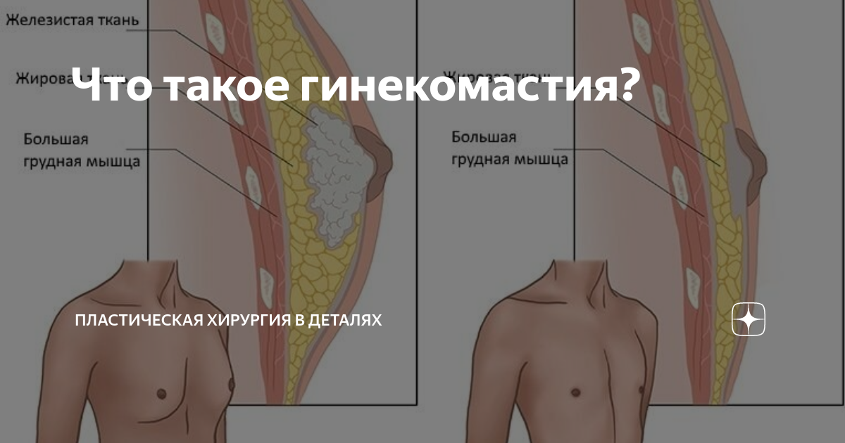 Пластический хирург назвал причины роста груди у мужчин