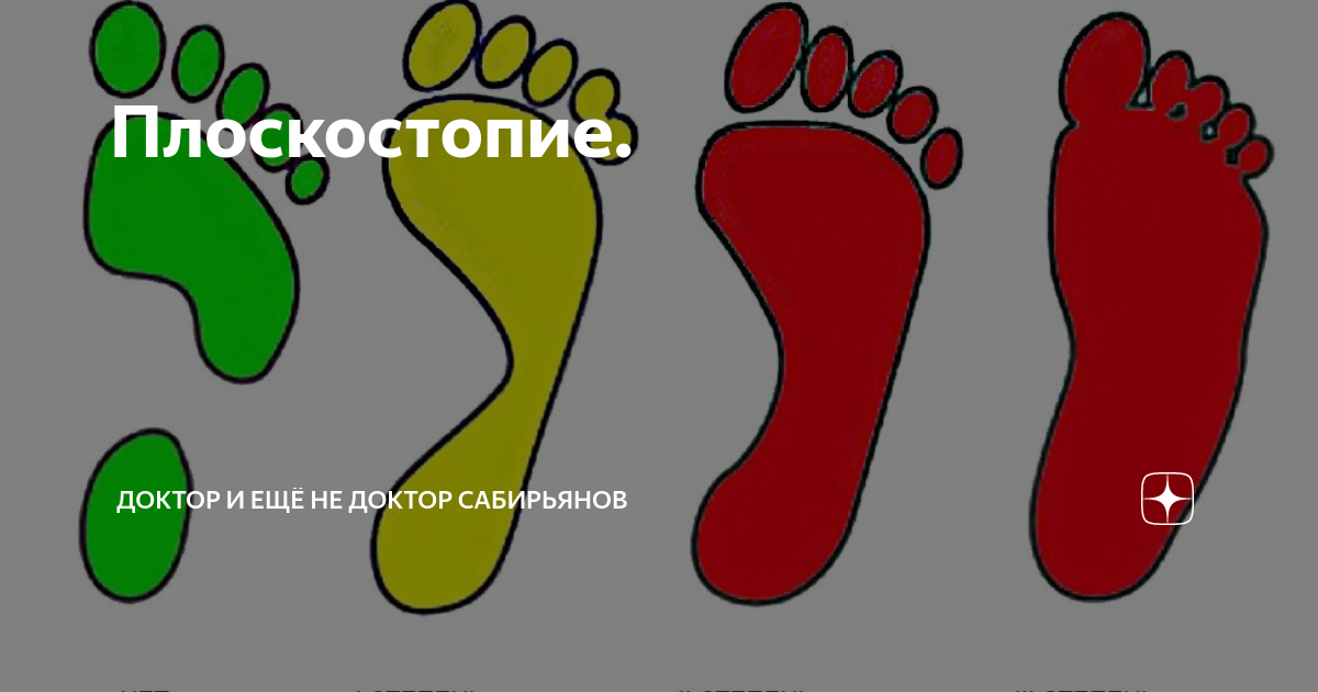 плоскостопие какие войска. плоскостопие какие войска. продольное плоскостопие 1 степени. плоскостопие 3 степени параметры.