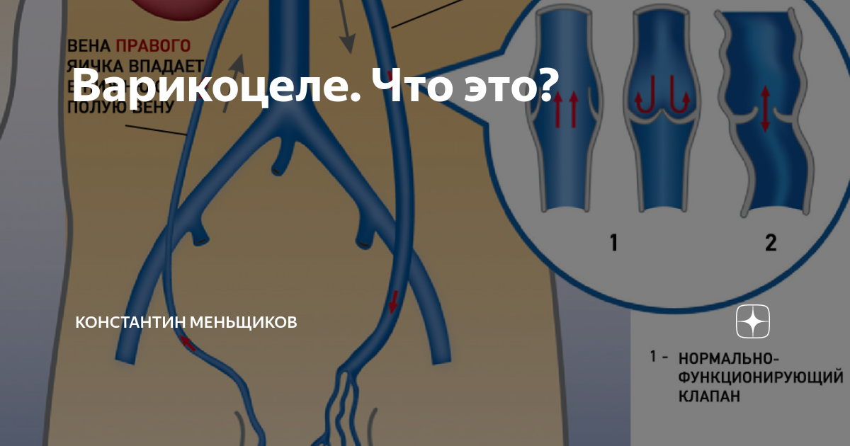 Как определить варикоцеле