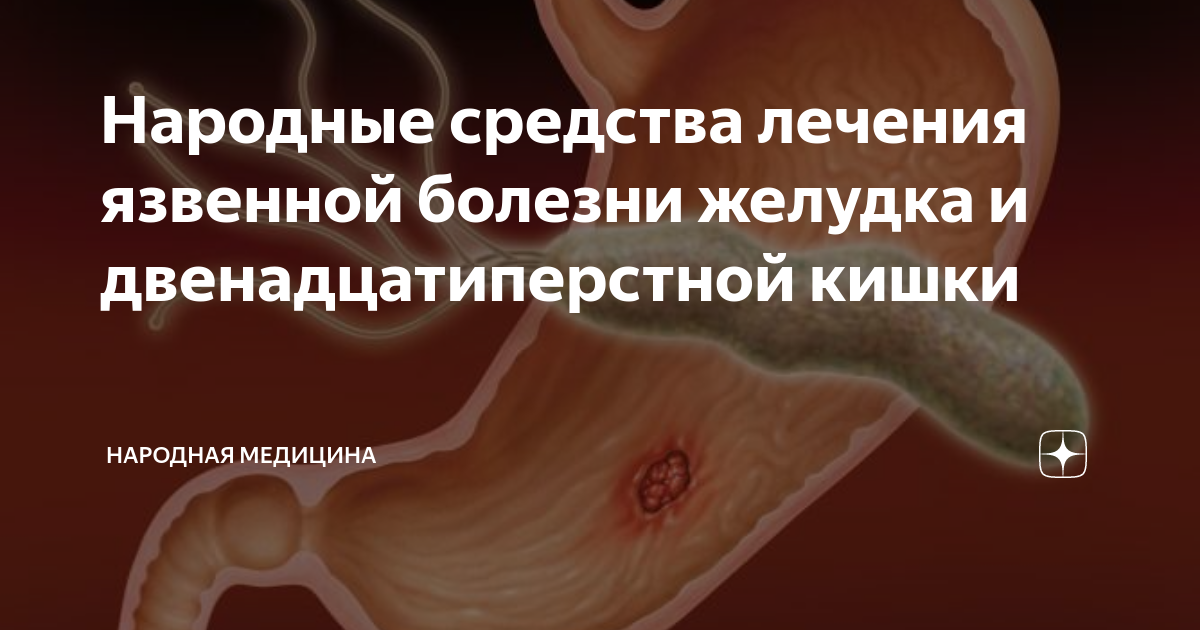 Народные средства лечения язвенной болезни желудка и двенадцатиперстной кишки