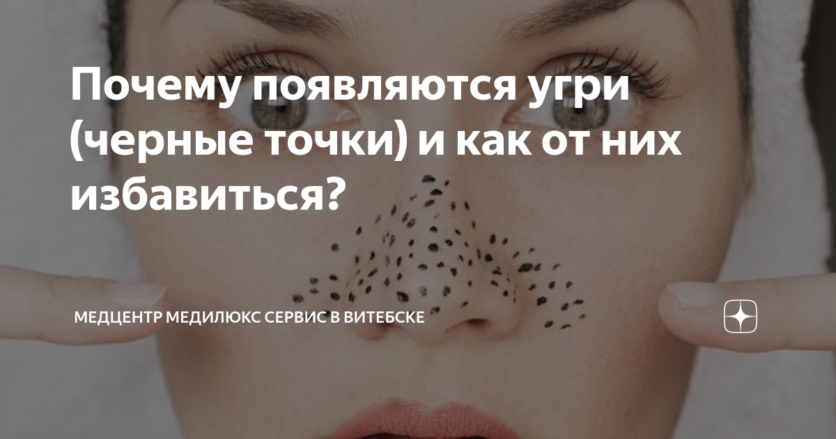 Почему появляются угри (черные точки) и как от них избавиться ...