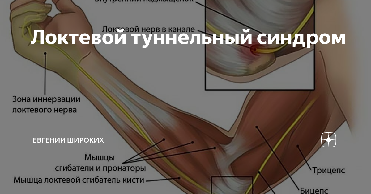 Невропатия (нейропатия) локтевого нерва