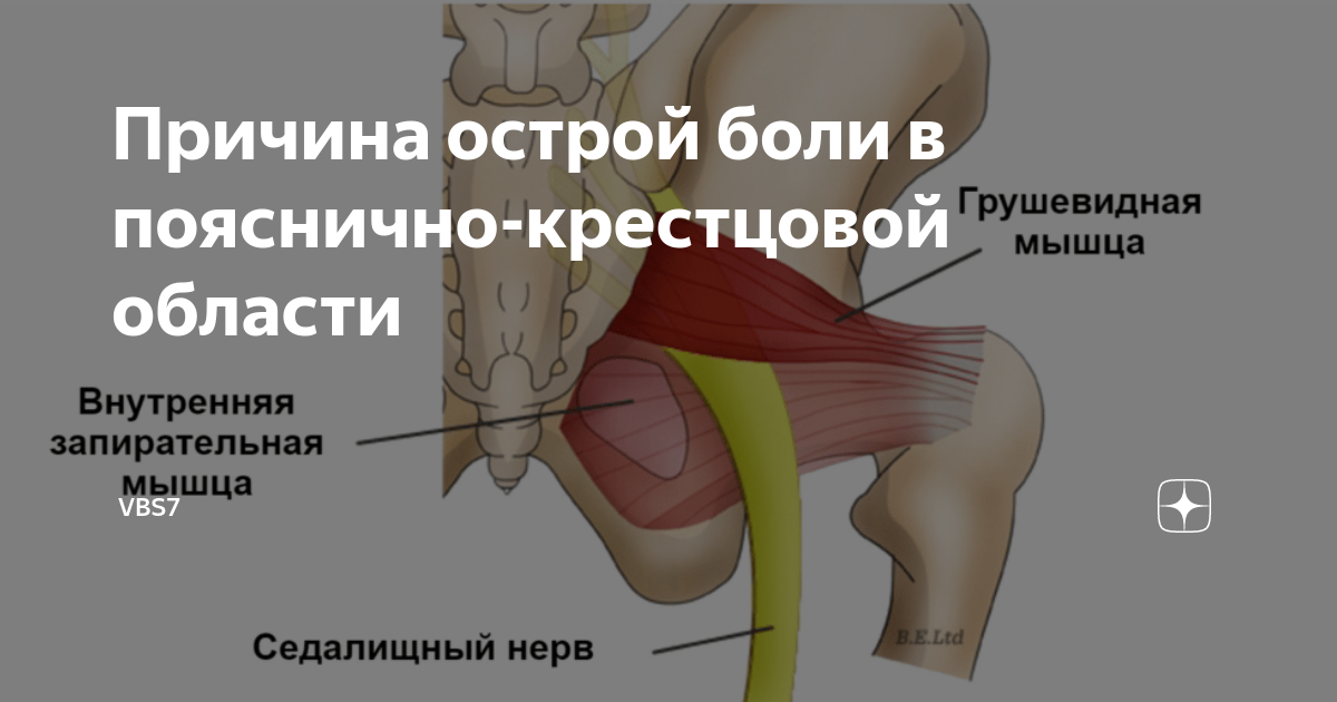 Причины острого мышечного спазма. Грушевидная мышца. Триггеры грушевидной мышцы. Грушевидная мышца воспаление. Грушевидная мышца и крестцовые отверстия.