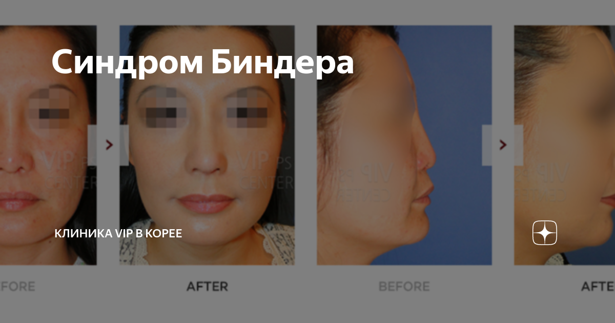Синдром Биндера | Клиника VIP в Корее | Дзен