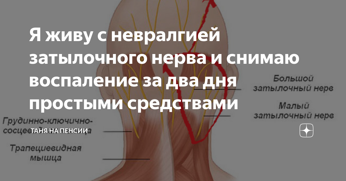 Воспаление нерва народными. Затылочный нерв затылочный воспаление. Невралгия затылочного нерва. Синдром большого затылочного нерва. Нейропатия затылочного нерва.