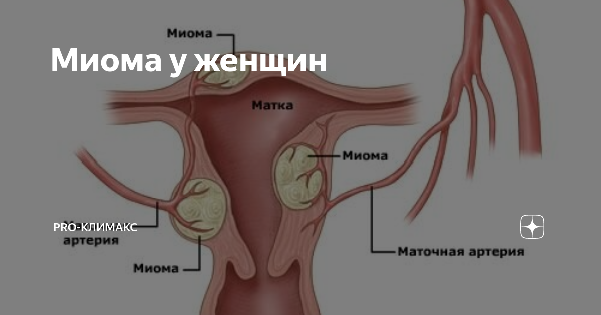 От чего миома появляется у женщин причины. От чего миома появляется у женщин причины