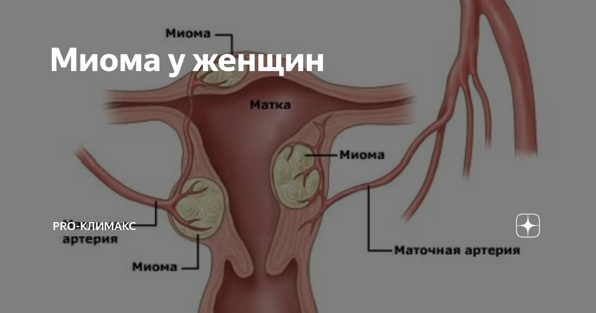 Эффективна ли настойка прополиса при миоме матки?