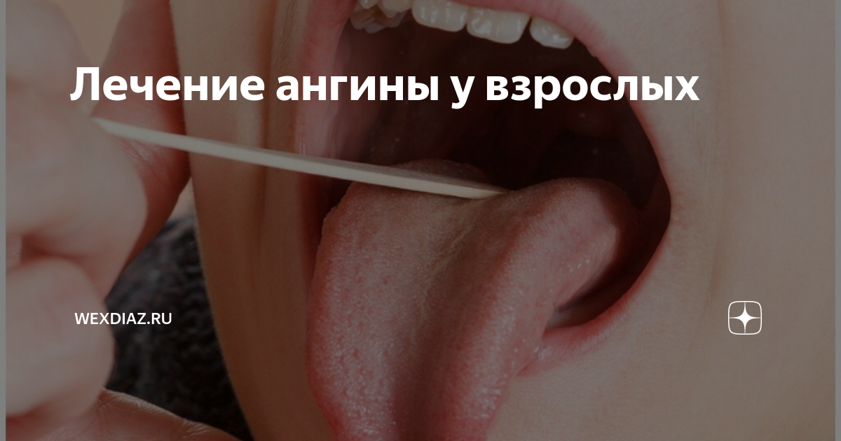 Лечение ангины у взрослых | Я в домике | Дзен