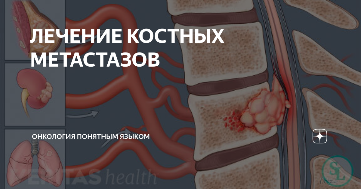 метастазы в позвоночнике лечение