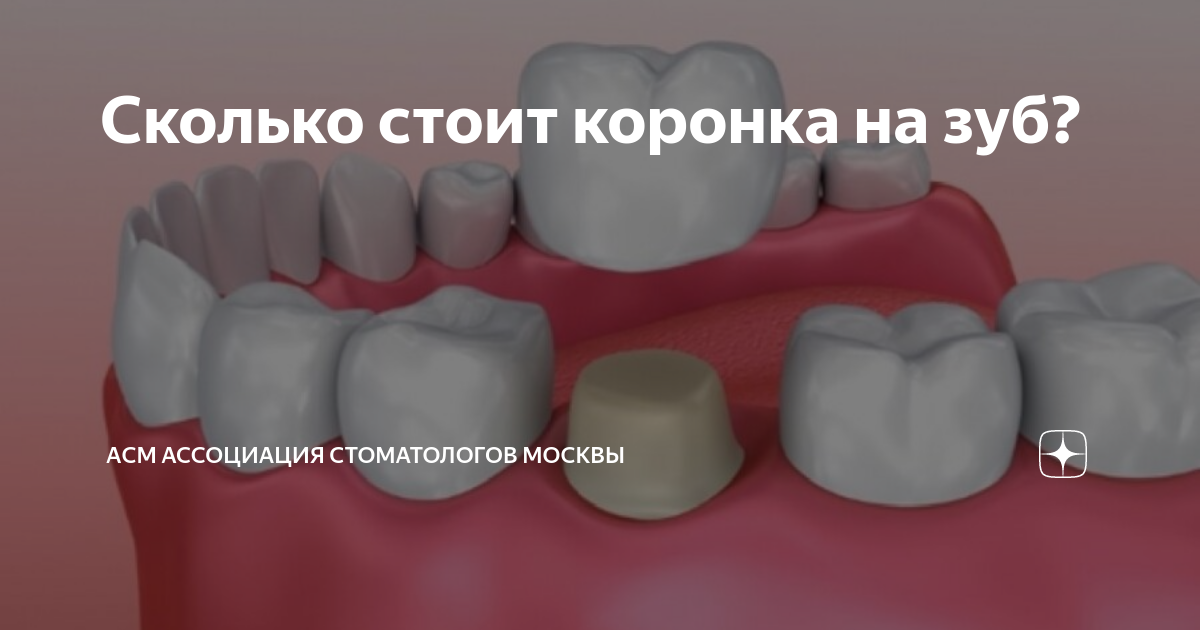 Сколько будет стоит коронка на зубы. Долго стоят коронки на зубы. сколько будет стоить коронка на зуб шестерка. сколько будет стоить коронка на один зуб. сколько будет стоить поставить коронку на зуб.