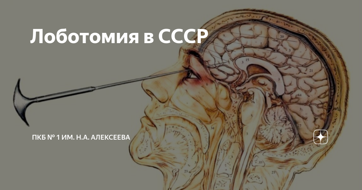 Лоботомия для чего Лоботомия для чего
