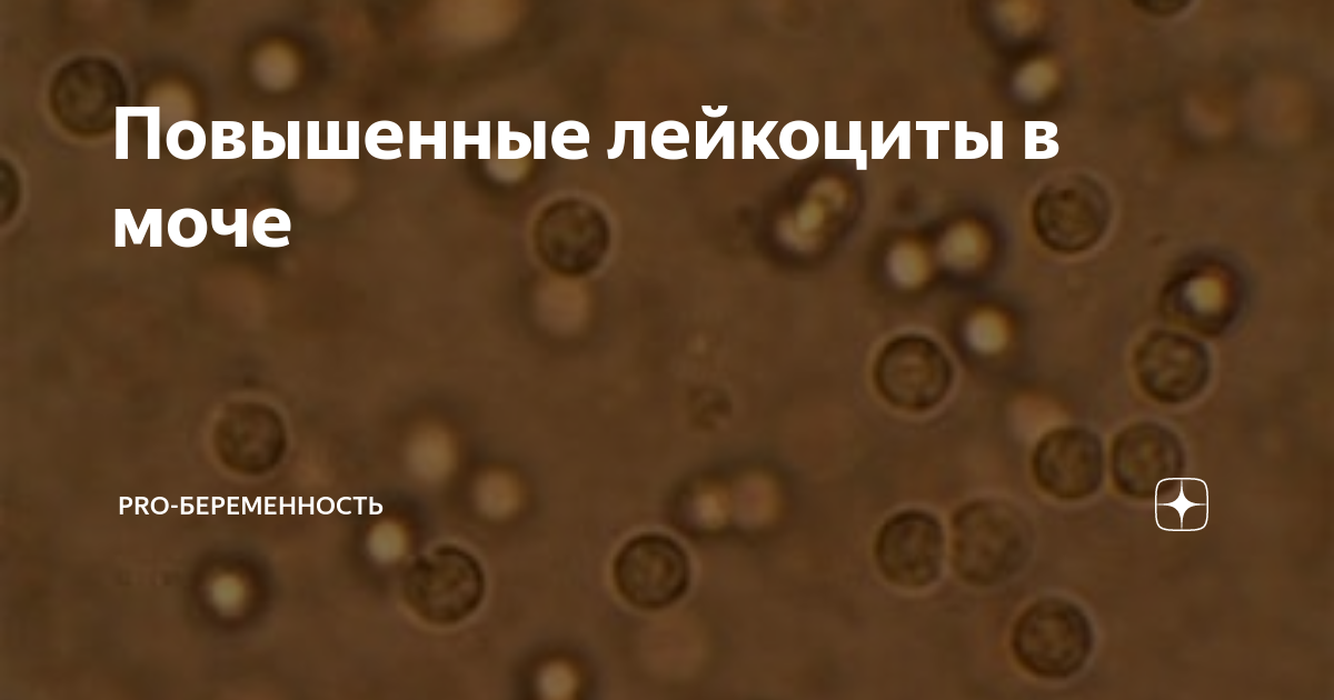 В анализе мочи повышены лейкоциты - 29 ответов - От года до двух лет - Форум Дети zavodgt.ru