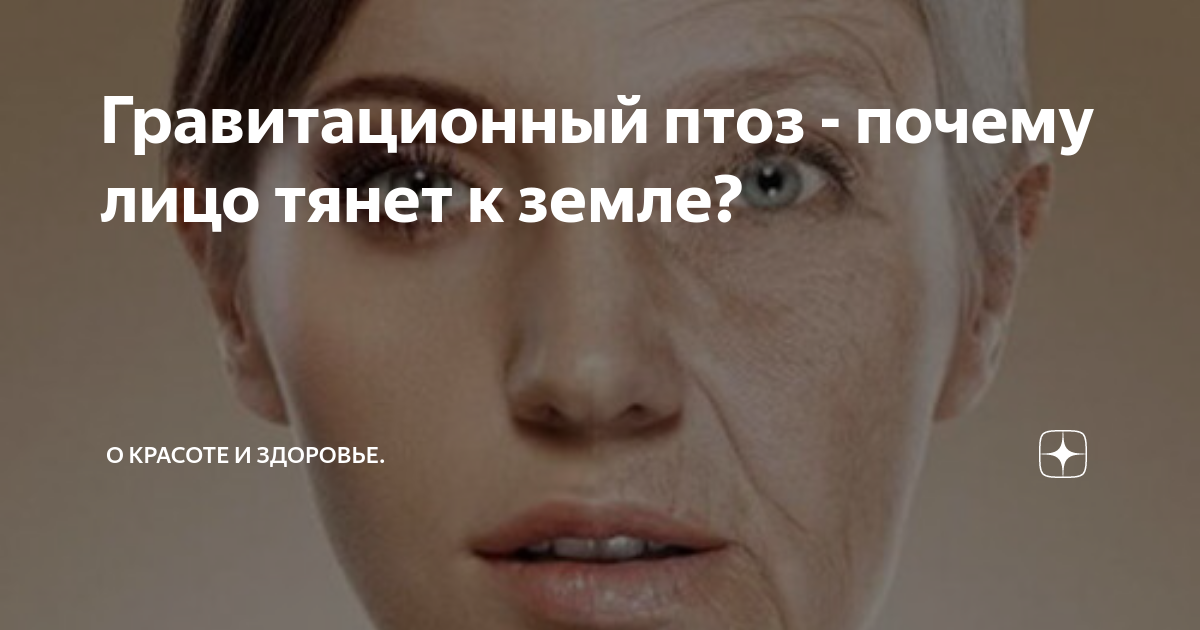 Потянуло лицо. Гравитационный птоз. Гравитационный птоз лица. Гравитация лица. Гравитационный птоз лица фото.
