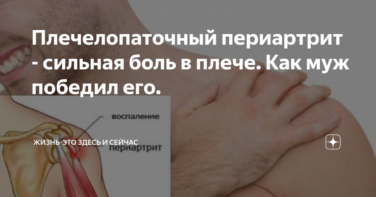 Периартрит плечевого сустава симптомы
