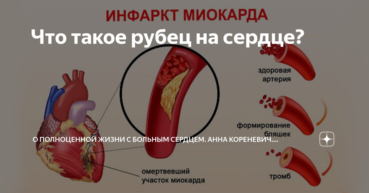 Как выглядит рубец после инфаркта Как выглядит рубец инфаркта миокарда фото презентация