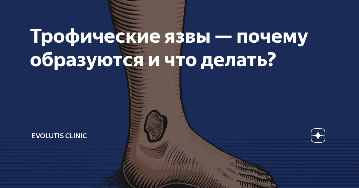 Трофические язвы — почему образуются и что делать? | Evolutis Clinic | Дзен