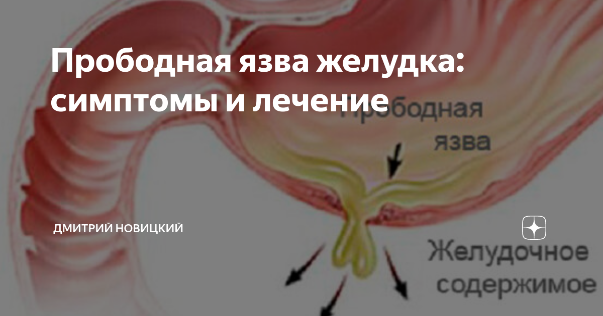 Прободная язва желудка симптомы. Клинические симптомы прободная язва.