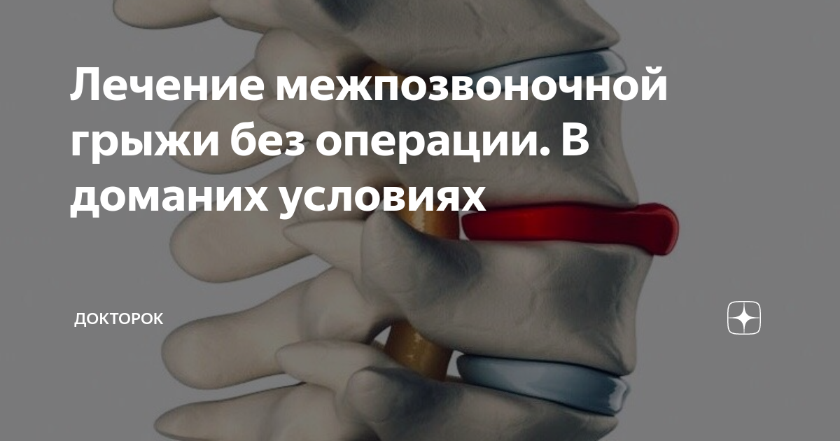 Лечение грыжи диска без операций