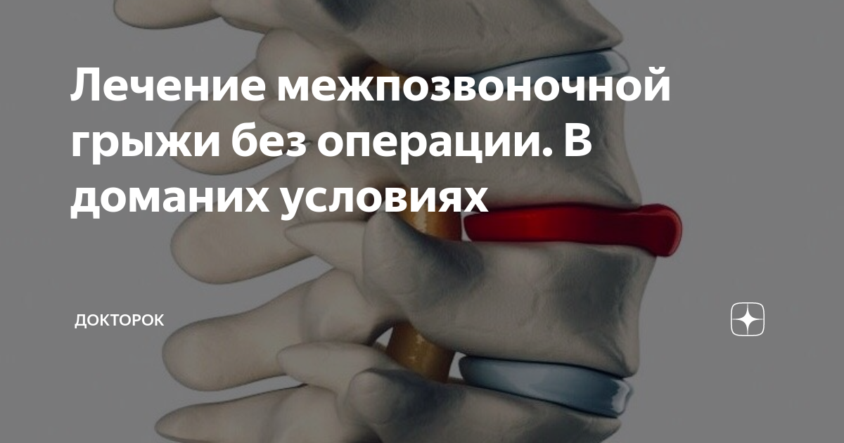 Вылечила грыжу позвоночника отзывы. Грыжа позвоночника без операции. Межпозвоночная грыжа лечение без операции. Как вылечить позвоночную грыжу без операций. Как вылечить грыжу позвоночника без операции.