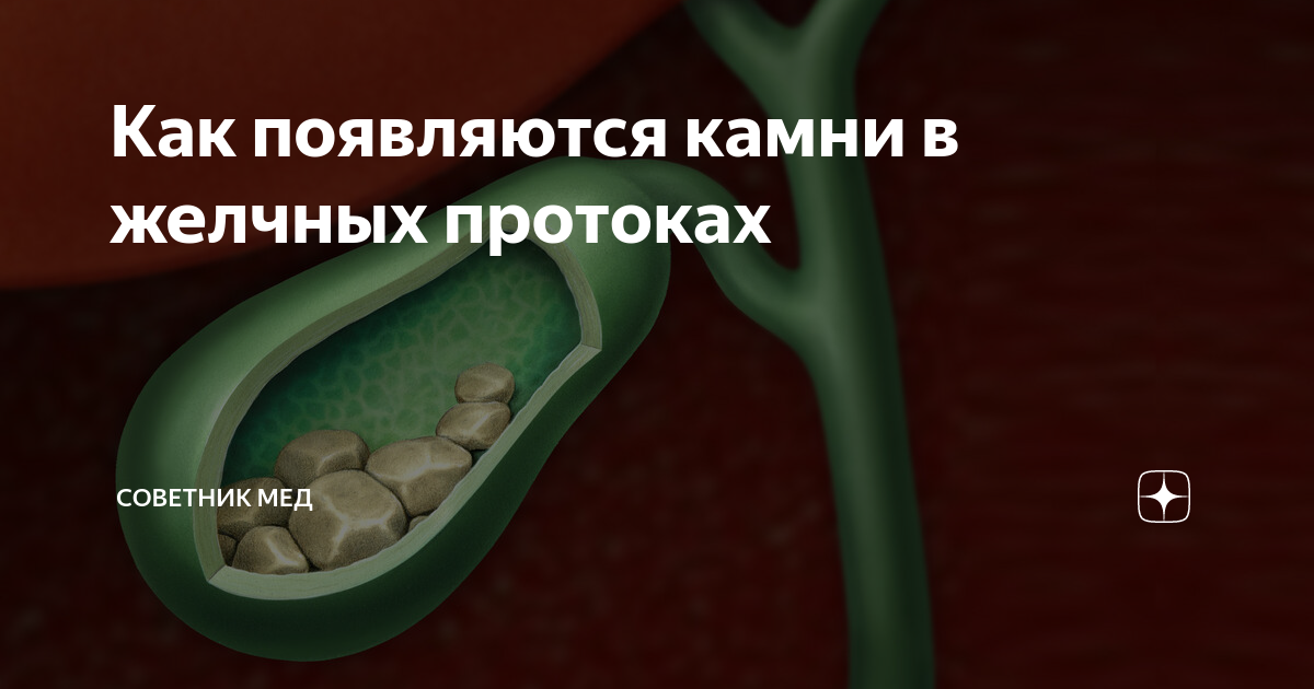 полипы пузырного протока. камень в протоке желчного пузыря. как удаляют камень из желчного протока. трансуретральная контактная литотрипсия. камень в пузырном протоке желчного пузыря.
