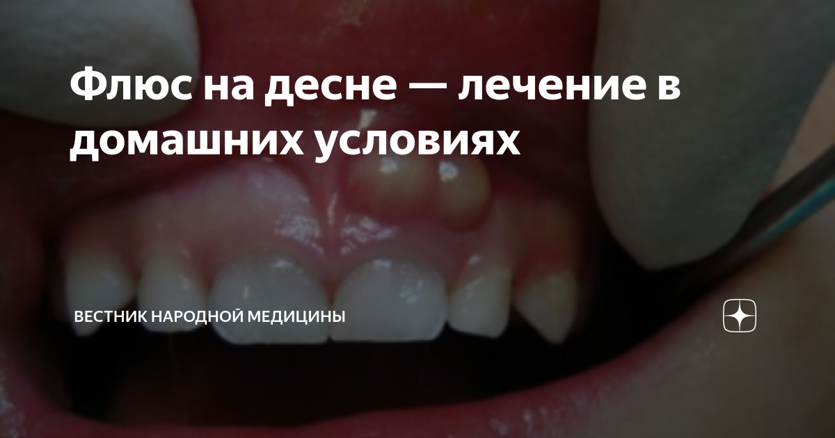 Гнойник (прыщ, абсцесс зуба) на десне – что делать, лечение нарыва на десне